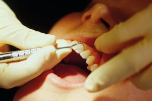 Teeth cleaning